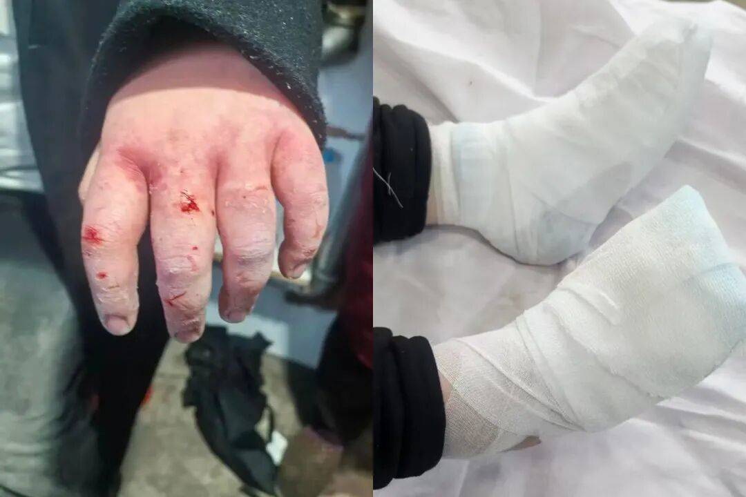 四川女大學生東北雪地裡摔暈後，3根手指或面臨截肢