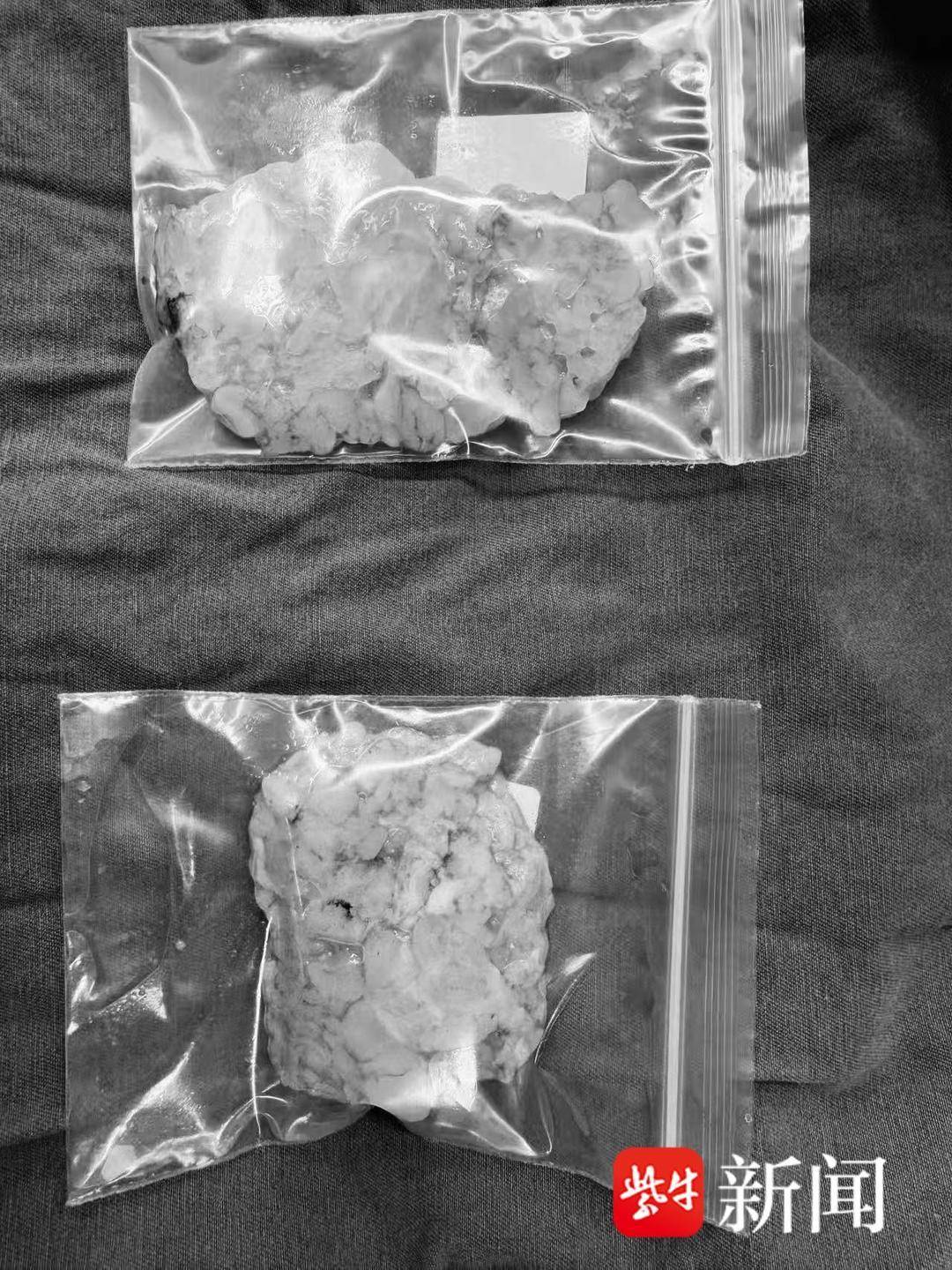 男性乳腺發育？乳暈微創，讓留學生在淮安“乳”釋重負